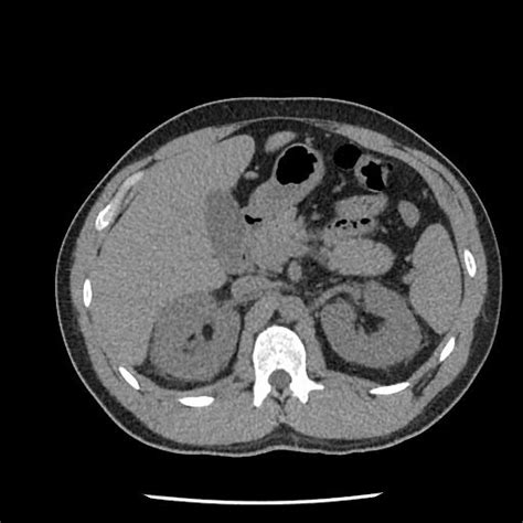 phenazopyridine induced renal failure